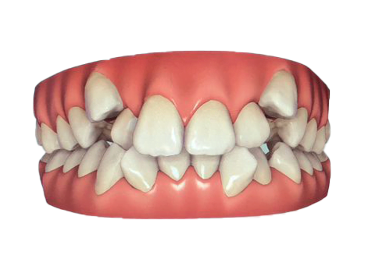 Antes do tratamento com alinhadores invisíveis - Odonto Yamada