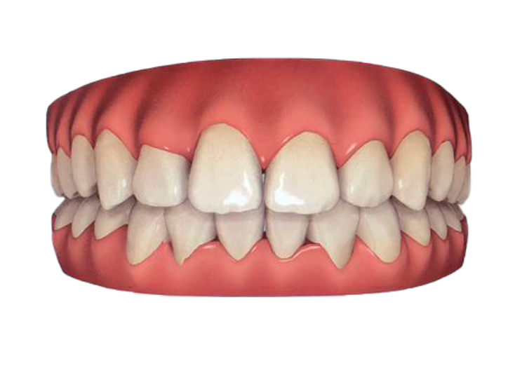 Depois do tratamento com alinhadores invisíveis - Odonto Yamada