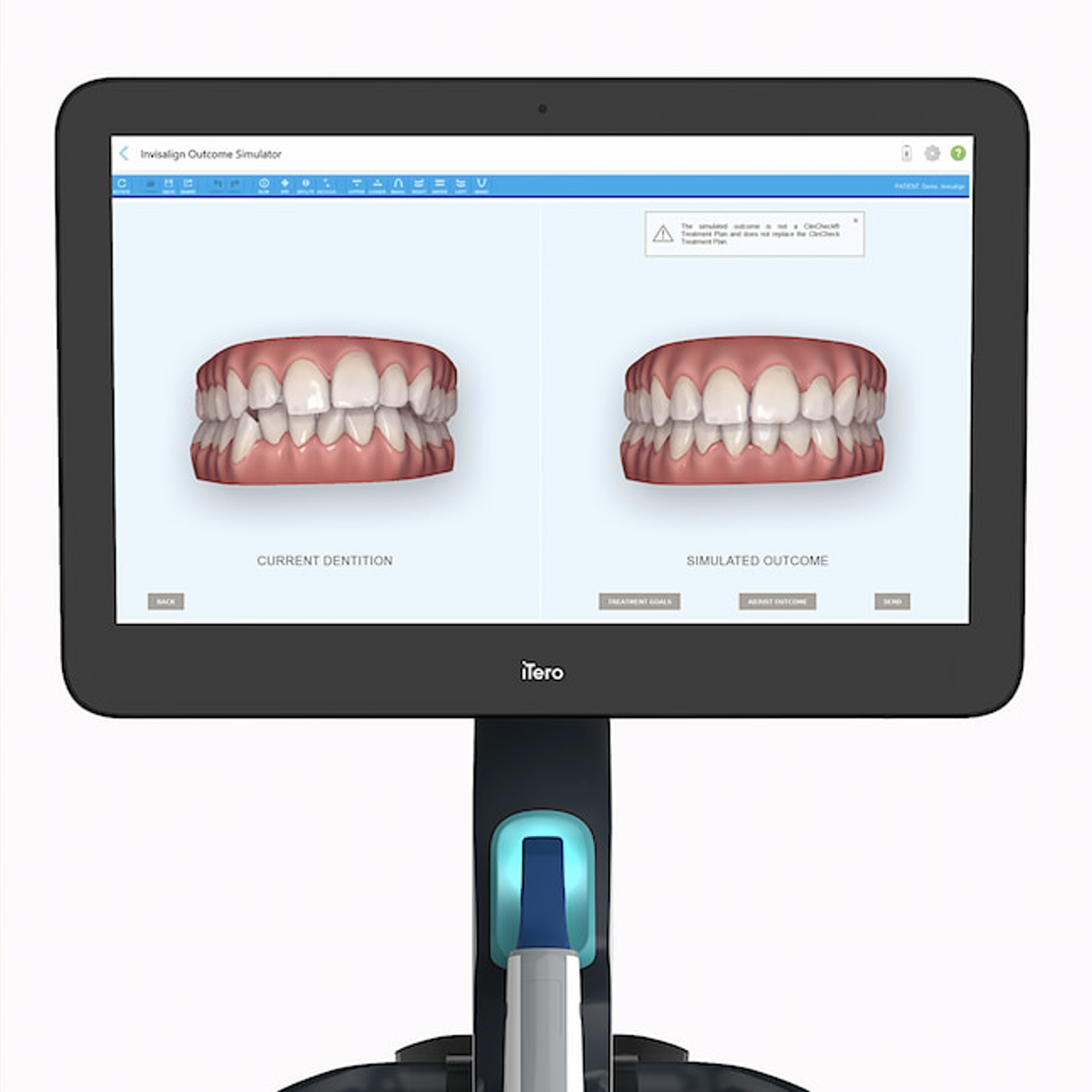 Clincheck dos alinhadores invisíveis - Odonto Yamada
