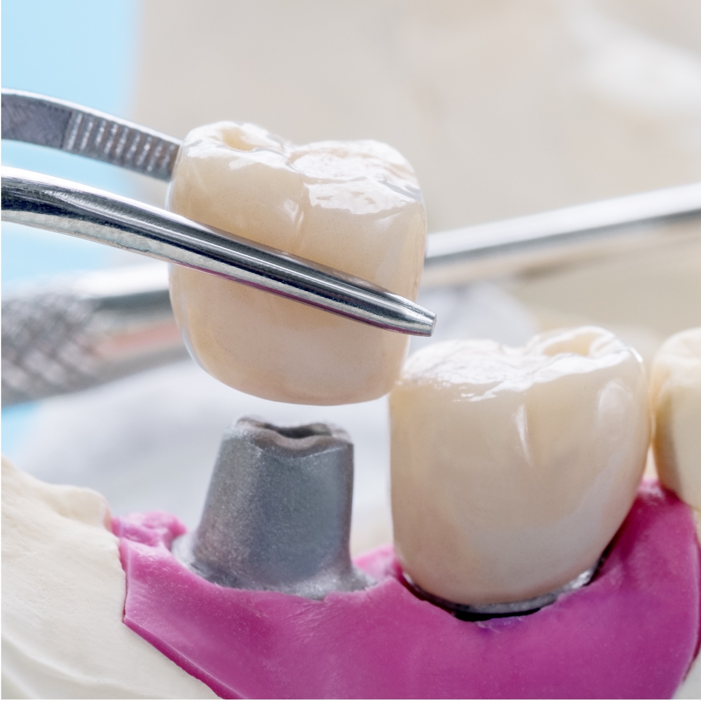 Coroa - Odonto Yamada