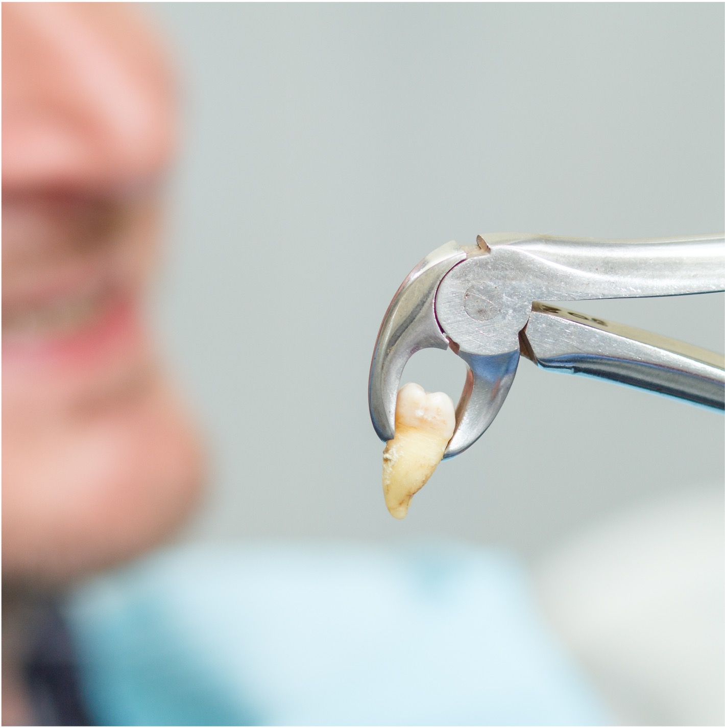 Serviço de exodontia e siso - Odonto Yamada