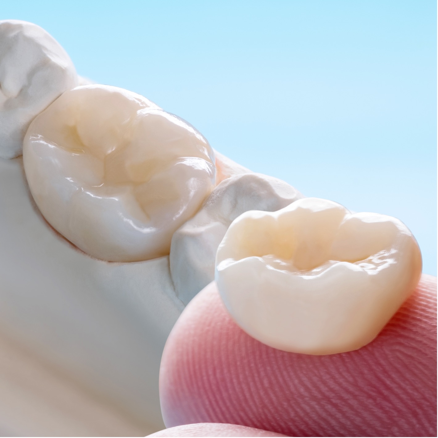 InlaysInlays, onlays e overlays - Odonto Yamada