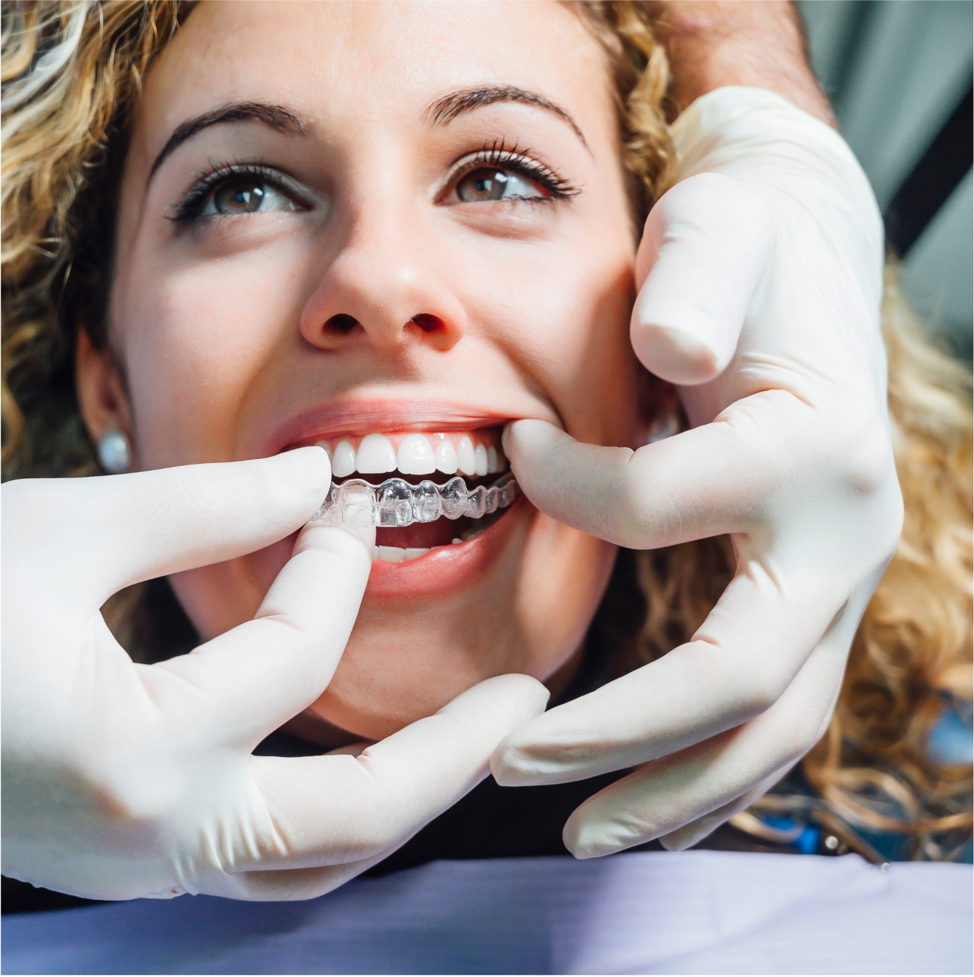 Manutenção dos alinhadores invisíveis - Odonto Yamada