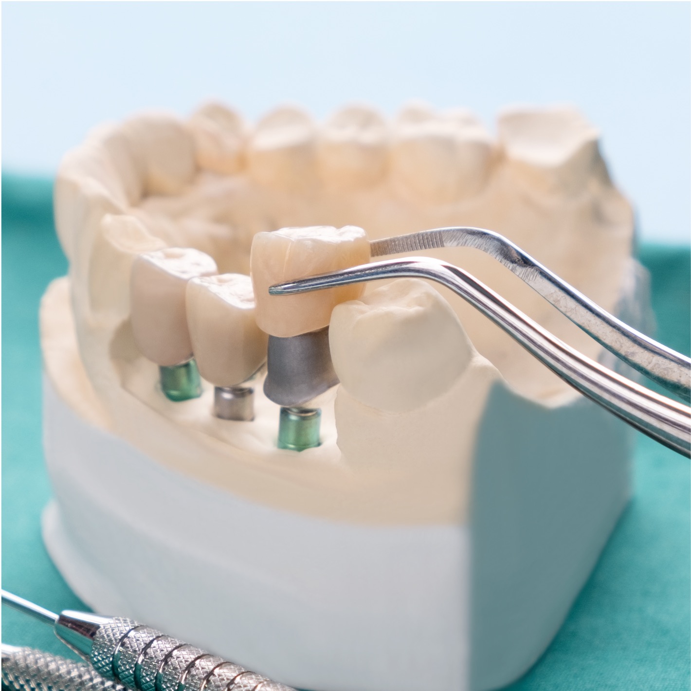 Prótese sobre implante - Odonto Yamada