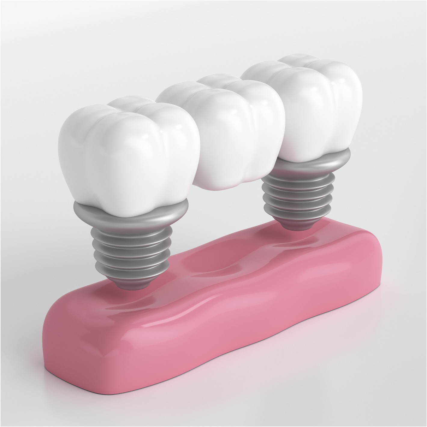 Implante duplo - Odonto Yamada