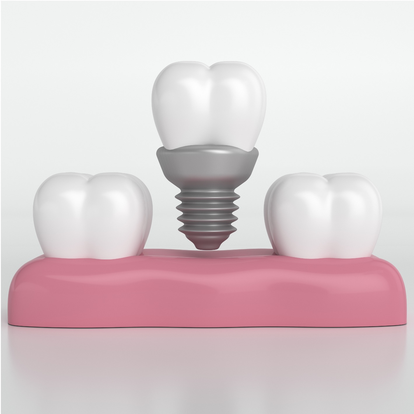 Implante unitário - Odonto Yamada