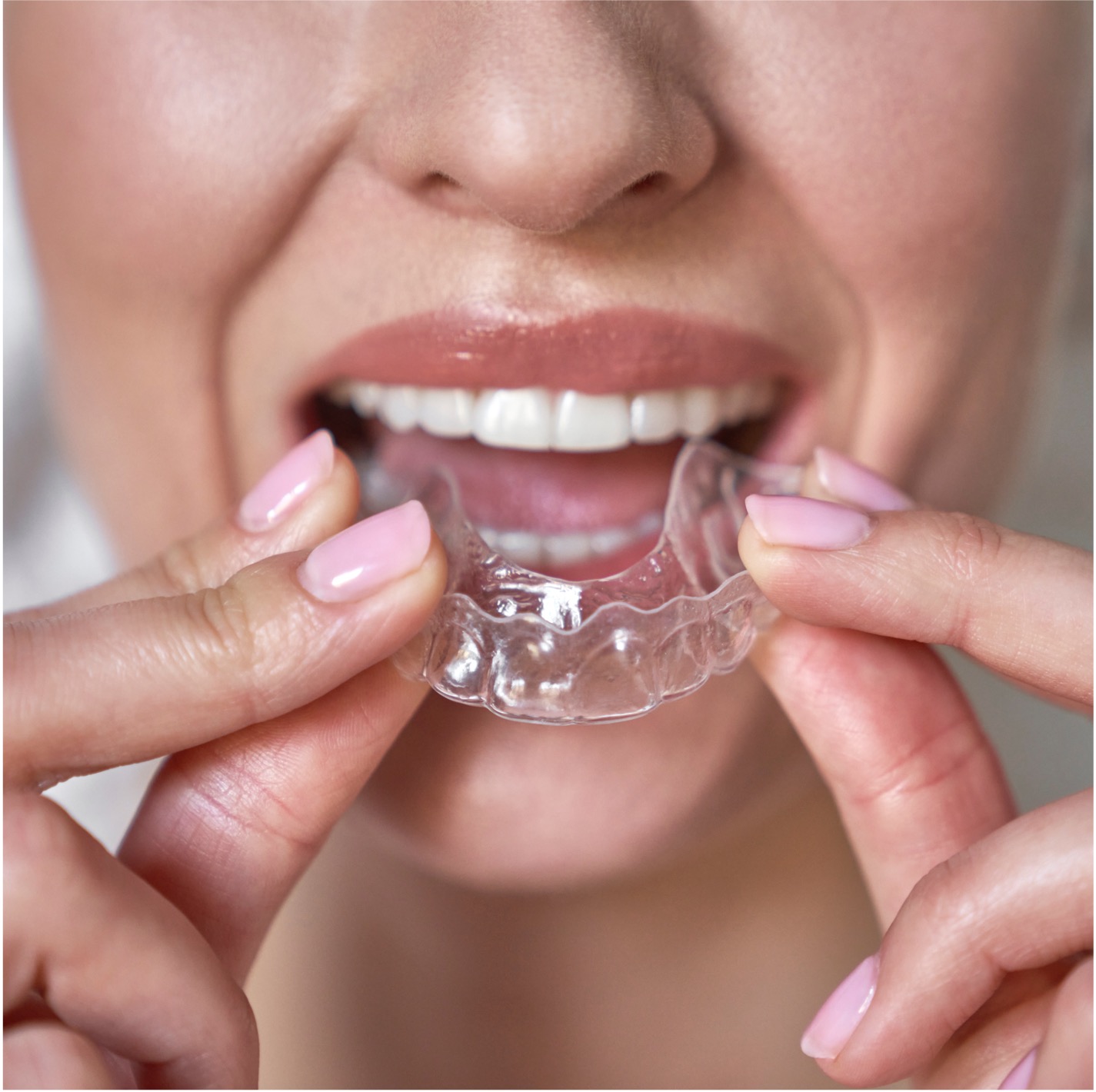 Instalação dos alinhadores invisíveis - Odonto Yamada