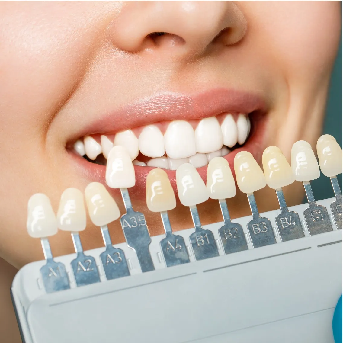Serviço de facetas em resina ou porcelana - Odonto Yamada