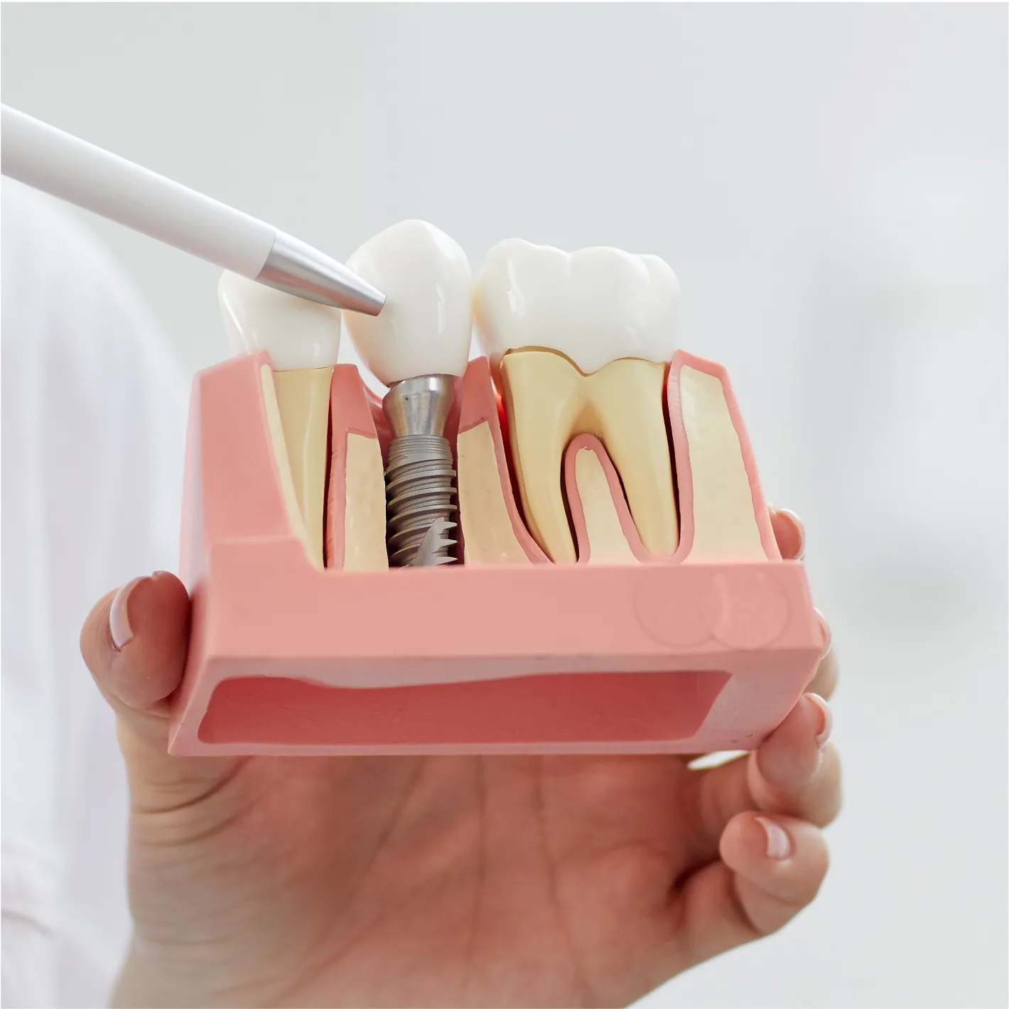 Serviço de implante dentário - Odonto Yamada