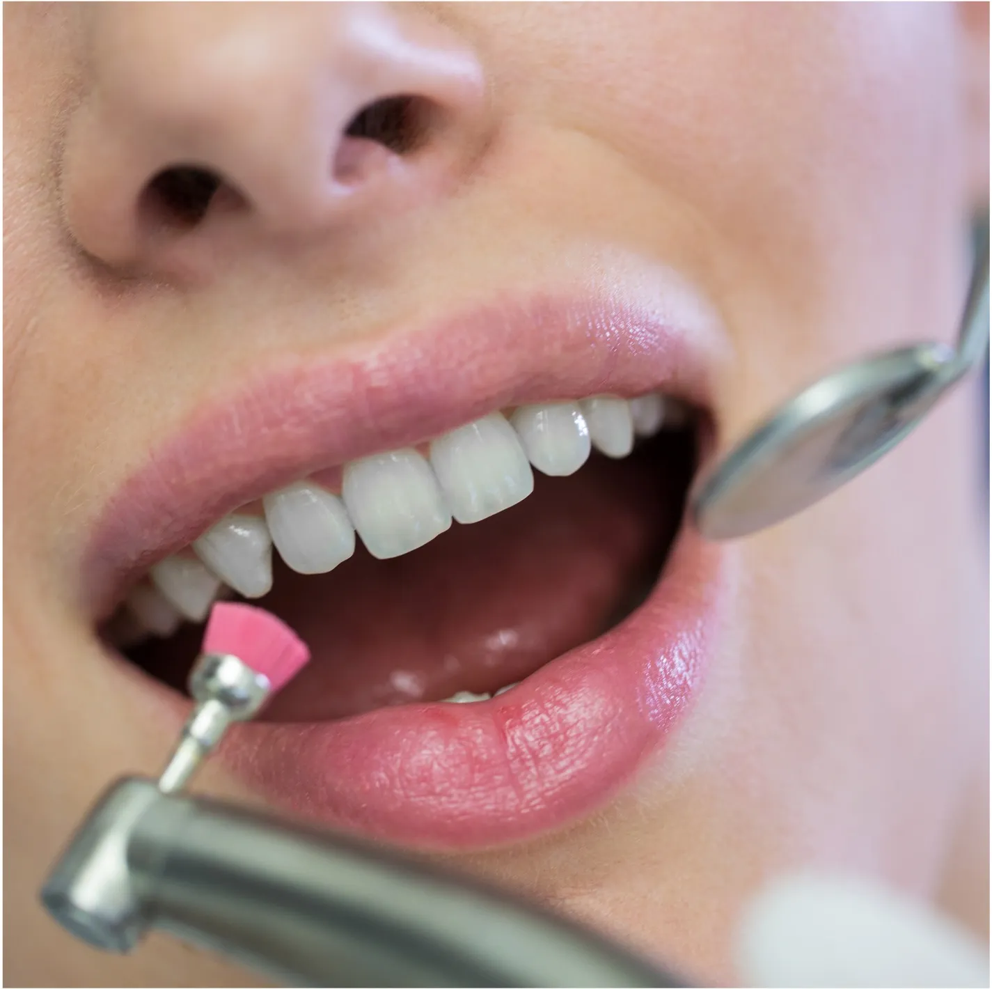 Limpeza dental profunda - Odonto Yamada